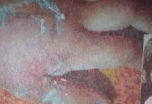 ਦੋ ਸਾਲ ਦੀ ਬੱਚੀ ਦਾ ਹੱਥ ਗਰਮ ਤੇਲ ‘ਚ ਪਾ ਕੇ ਸਾੜਿਆ, ਦਾਦੀ ਗਿਰਫ਼ਤਾਰ