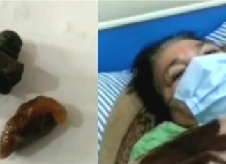 1988 ‘ਚ ਬੰਬ ਧਮਾਕੇ ‘ਚ ਵਾਲ-ਵਾਲ ਬਚੀ ਸੀ ਔਰਤ, 32 ਸਾਲ ਬਾਅਦ ਸਰੀਰ ‘ਚੋਂ ਨਿਕਲੇ ਬੰਬ ਦੇ ਟੁਕੜੇ