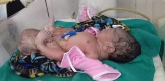 ਔਰਤ ਨੇ 2 ਸਿਰਾਂ ਵਾਲੀ ਬੱਚੀ ਨੂੰ ਦਿੱਤਾ ਜਨਮ, ਡਿਲੀਵਰੀ ਹੋਈ ਨਾਰਮਲ, ਡਾਕਟਰ ਵੀ ਹੈਰਾਨ