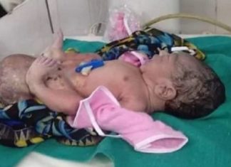 ਔਰਤ ਨੇ 2 ਸਿਰਾਂ ਵਾਲੀ ਬੱਚੀ ਨੂੰ ਦਿੱਤਾ ਜਨਮ, ਡਿਲੀਵਰੀ ਹੋਈ ਨਾਰਮਲ, ਡਾਕਟਰ ਵੀ ਹੈਰਾਨ