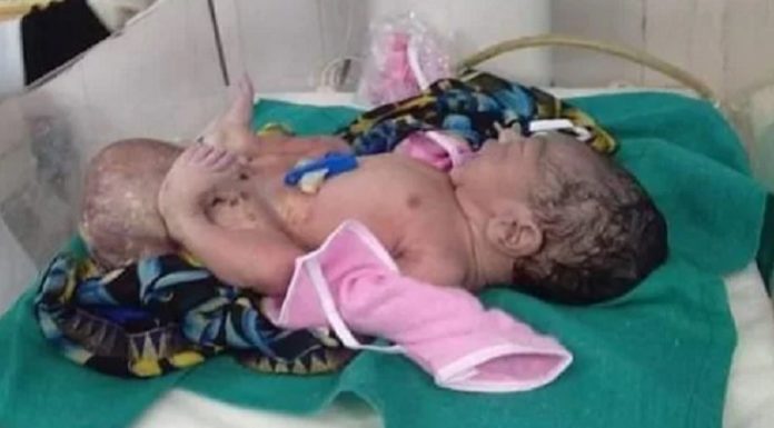 ਔਰਤ ਨੇ 2 ਸਿਰਾਂ ਵਾਲੀ ਬੱਚੀ ਨੂੰ ਦਿੱਤਾ ਜਨਮ, ਡਿਲੀਵਰੀ ਹੋਈ ਨਾਰਮਲ, ਡਾਕਟਰ ਵੀ ਹੈਰਾਨ