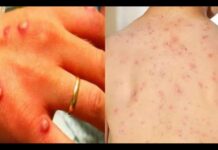 ਭਾਰਤ ‘ਚ ਮੰਕੀਪੌਕਸ ਦੇ 2 ਮਰੀਜ਼ ਮਿਲੇ, ਪੜ੍ਹੋ ਇਹ ਬਿਮਾਰੀ ਕਿਵੇਂ ਫੈਲਦੀ ਹੈ