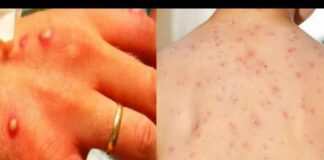 ਭਾਰਤ ‘ਚ ਮੰਕੀਪੌਕਸ ਦੇ 2 ਮਰੀਜ਼ ਮਿਲੇ, ਪੜ੍ਹੋ ਇਹ ਬਿਮਾਰੀ ਕਿਵੇਂ ਫੈਲਦੀ ਹੈ