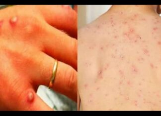 ਭਾਰਤ ‘ਚ ਮੰਕੀਪੌਕਸ ਦੇ 2 ਮਰੀਜ਼ ਮਿਲੇ, ਪੜ੍ਹੋ ਇਹ ਬਿਮਾਰੀ ਕਿਵੇਂ ਫੈਲਦੀ ਹੈ