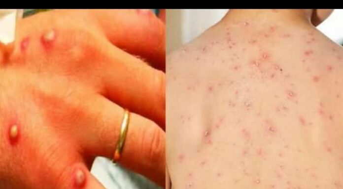 ਭਾਰਤ ‘ਚ ਮੰਕੀਪੌਕਸ ਦੇ 2 ਮਰੀਜ਼ ਮਿਲੇ, ਪੜ੍ਹੋ ਇਹ ਬਿਮਾਰੀ ਕਿਵੇਂ ਫੈਲਦੀ ਹੈ
