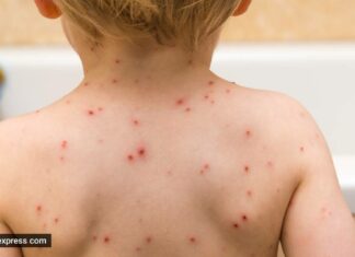 ਜੇਕਰ ਤੁਹਾਡੀਆਂ ਬੱਚਿਆਂ ਦੇ ਸਰੀਰ ‘ਤੇ ਲਾਲ ਦਾਣੇ ਨਿਕਲ ਰਹੇ ਨੇ ਤਾਂ ਘਬਰਾਓ ਨਾ, ਇਹ ਮੌਕੀਪੌਕਸ ਨਹੀਂ ਹੈ