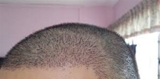 ਸਾਵਧਾਨ ! ਹੇਅਰ ਟਰਾਂਸਪਲਾਂਟ ਕਰਵਾਉਣ ਤੋਂ ਪਹਿਲਾਂ ਇਨ੍ਹਾਂ ਗੱਲਾਂ ਦਾ ਰੱਖੋ ਧਿਆਨ, ਨਹੀਂ ਤਾਂ ਹੋ ਸਕਦੀ ਹੈ ਮੌਤ