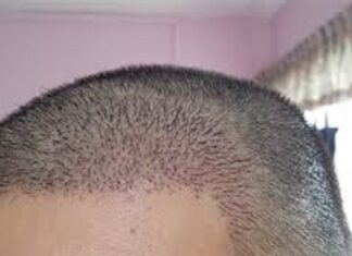 ਸਾਵਧਾਨ ! ਹੇਅਰ ਟਰਾਂਸਪਲਾਂਟ ਕਰਵਾਉਣ ਤੋਂ ਪਹਿਲਾਂ ਇਨ੍ਹਾਂ ਗੱਲਾਂ ਦਾ ਰੱਖੋ ਧਿਆਨ, ਨਹੀਂ ਤਾਂ ਹੋ ਸਕਦੀ ਹੈ ਮੌਤ