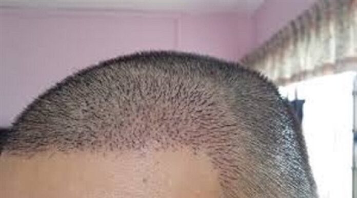 ਸਾਵਧਾਨ ! ਹੇਅਰ ਟਰਾਂਸਪਲਾਂਟ ਕਰਵਾਉਣ ਤੋਂ ਪਹਿਲਾਂ ਇਨ੍ਹਾਂ ਗੱਲਾਂ ਦਾ ਰੱਖੋ ਧਿਆਨ, ਨਹੀਂ ਤਾਂ ਹੋ ਸਕਦੀ ਹੈ ਮੌਤ