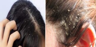 ਸਰਦੀਆਂ ‘ਚ ਡੈਂਡਰਫ ਖਤਰਨਾਕ ! 70 ਫੀਸਦੀ ਭਾਰਤੀ ਇਸ ਤੋਂ ਪ੍ਰੇਸ਼ਾਨ, ਸਮੇਂ ਸਿਰ ਨਾ ਕੀਤਾ ਇਲਾਜ ਤਾਂ ਸੋਰਾਇਸਿਸ ਦਾ ਬਣ ਸਕਦੈ ਕਾਰਨ