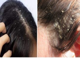 ਸਰਦੀਆਂ ‘ਚ ਡੈਂਡਰਫ ਖਤਰਨਾਕ ! 70 ਫੀਸਦੀ ਭਾਰਤੀ ਇਸ ਤੋਂ ਪ੍ਰੇਸ਼ਾਨ, ਸਮੇਂ ਸਿਰ ਨਾ ਕੀਤਾ ਇਲਾਜ ਤਾਂ ਸੋਰਾਇਸਿਸ ਦਾ ਬਣ ਸਕਦੈ ਕਾਰਨ