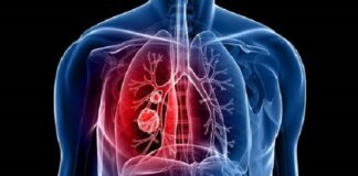 ਖੋਜਕਰਤਾਵਾਂ ਦਾ ਦਾਅਵਾ : ਫੇਫੜਿਆਂ ਦੇ ਕੈਂਸਰ ਨੂੰ ਬੈਕਟੀਰੀਆ ਰਾਹੀਂ ਕੀਤਾ ਜਾ ਸਕਦੈ ਠੀਕ