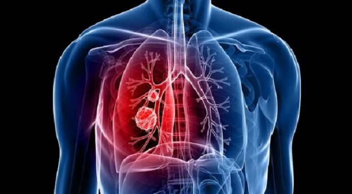 ਖੋਜਕਰਤਾਵਾਂ ਦਾ ਦਾਅਵਾ : ਫੇਫੜਿਆਂ ਦੇ ਕੈਂਸਰ ਨੂੰ ਬੈਕਟੀਰੀਆ ਰਾਹੀਂ ਕੀਤਾ ਜਾ ਸਕਦੈ ਠੀਕ