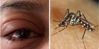 ਪੰਜਾਬ ‘ਚ ਡੇਂਗੂ ਦੇ 440 ਮਾਮਲੇ ਆਏ ਸਾਹਮਣੇ, ਅੱਖਾਂ ‘ਚ ਫਲੂ ਦਾ ਖ਼ਤਰਾ ਵੀ ਵਧਿਆ