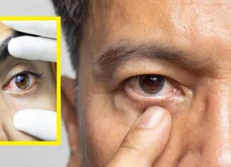 ਚੰਗੀ ਖਬਰ ! ਭਾਰਤ ‘ਚ ਅੱਖਾਂ ਦੀ ਬਿਮਾਰੀ ਟ੍ਰੈਕੋਮਾ ਪੂਰੀ ਤਰ੍ਹਾਂ ਹੋਈ ਖਤਮ, WHO ਨੇ ਦਿੱਤੀ ਵਧਾਈ