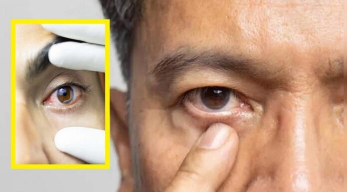 ਚੰਗੀ ਖਬਰ ! ਭਾਰਤ ‘ਚ ਅੱਖਾਂ ਦੀ ਬਿਮਾਰੀ ਟ੍ਰੈਕੋਮਾ ਪੂਰੀ ਤਰ੍ਹਾਂ ਹੋਈ ਖਤਮ, WHO ਨੇ ਦਿੱਤੀ ਵਧਾਈ