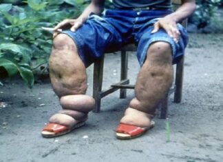 ਰਿਪੋਰਟ ‘ਚ ਦਾਅਵਾ ! ਭਾਰਤ ‘ਚ 74 ਕਰੋੜ ਲੋਕਾਂ ਨੂੰ ਫਾਈਲੇਰੀਆ ਬਿਮਾਰੀ ਦਾ ਖਤਰਾ, ਜਾਣੋ ਇਸ ਦੇ ਲੱਛਣ ਤੇ ਬਚਾਅ