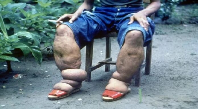 ਰਿਪੋਰਟ ‘ਚ ਦਾਅਵਾ ! ਭਾਰਤ ‘ਚ 74 ਕਰੋੜ ਲੋਕਾਂ ਨੂੰ ਫਾਈਲੇਰੀਆ ਬਿਮਾਰੀ ਦਾ ਖਤਰਾ, ਜਾਣੋ ਇਸ ਦੇ ਲੱਛਣ ਤੇ ਬਚਾਅ