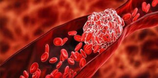 ਬਲੱਡ ਕਲੌਟਿੰਗ (ਖੂਨ ਦਾ ਜੰਮਣਾ): ਜੀਵਨ ਰੱਖਿਅਕ ਵੀ ਤੇ ਜਾਨਲੇਵਾ ਵੀ; ਜਾਣੋ ਕਦੋਂ ਬਣ ਜਾਂਦੀ ਹੈ ਇਹ ਗੰਭੀਰ