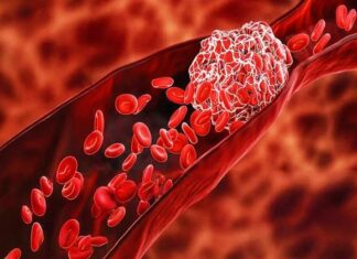 ਬਲੱਡ ਕਲੌਟਿੰਗ (ਖੂਨ ਦਾ ਜੰਮਣਾ): ਜੀਵਨ ਰੱਖਿਅਕ ਵੀ ਤੇ ਜਾਨਲੇਵਾ ਵੀ; ਜਾਣੋ ਕਦੋਂ ਬਣ ਜਾਂਦੀ ਹੈ ਇਹ ਗੰਭੀਰ